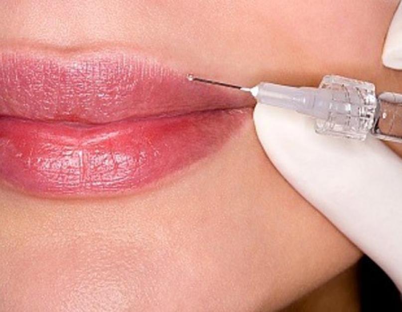 Botoxi süstid huultele – ideaalne vorm ühe protseduuriga.  Botoxi süstid huultele Kuidas Botoxi süstida häbememokkadesse