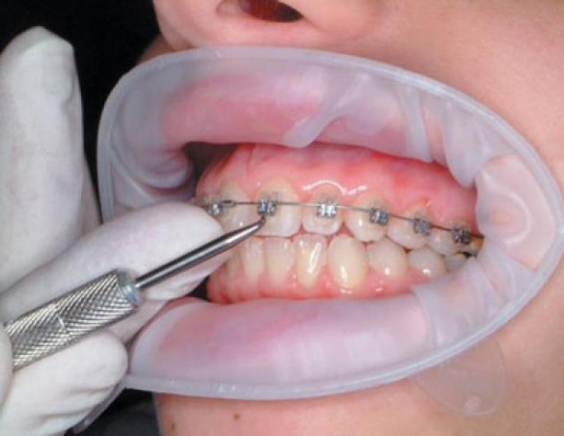 Alexanderi breketid – kvaliteetne hammaste joondamine.  Traksid Parimad nähtamatud breketid – Incognito