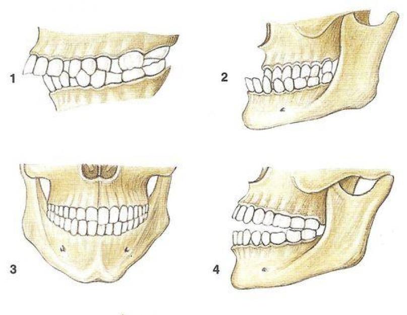 Hambavalemi täitmise reeglid ja sümbolid.  Kuidas nummerdatakse hambaid hambaravis.  MI - mediaalselt sisselõikeõõnsus, st asub esihammaste kroonide mediaalsel pinnal ja lõikeservas