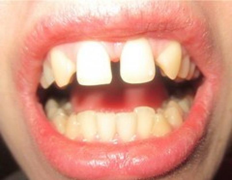 एडेंटिया उपचार को कम करता है।  दांतों का एडेंटिया।  वीडियो - संपूर्ण एडेंटिया