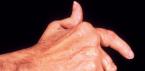 If your fingers hurt and do not clench into a fist, you need to contact a rheumatologist
