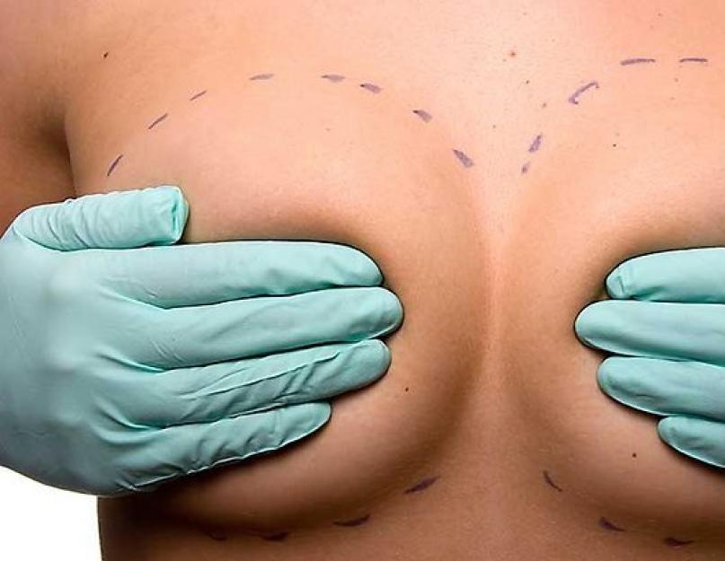 स्तन ग्रंथियों का फाइब्रोएडीनोमा: लक्षण, कारण, निदान, उपचार।  स्तन फाइब्रोएडीनोमा क्या है?  स्तन फाइब्रोएडीनोमा के प्रकार और लक्षण, इसका उपचार और निदान स्तन का एडेनोफाइब्रोमा