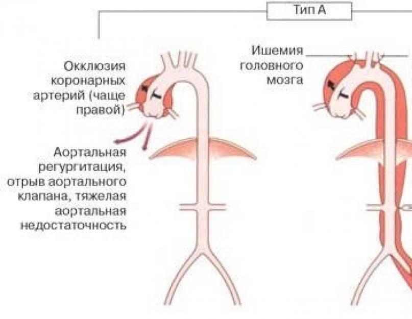 Ettevalmistavad testid aordi aneurüsmi lahkamise teemal.  Aordi aneurüsmi lahkamise tunnused.  Rindkere röntgen