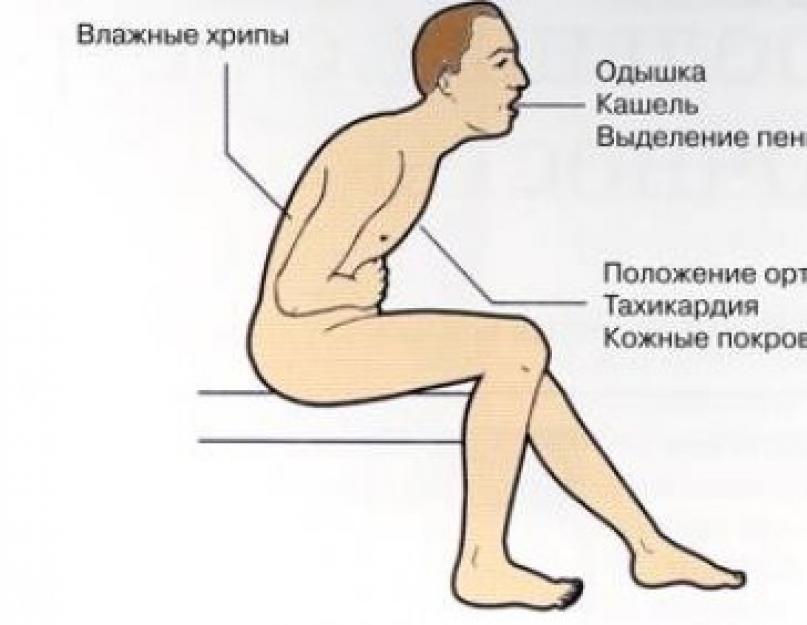 Инвалидность при астме. Поза ортопноэ. Положение ортопноэ у детей. Положение ортопноэ характерно для.