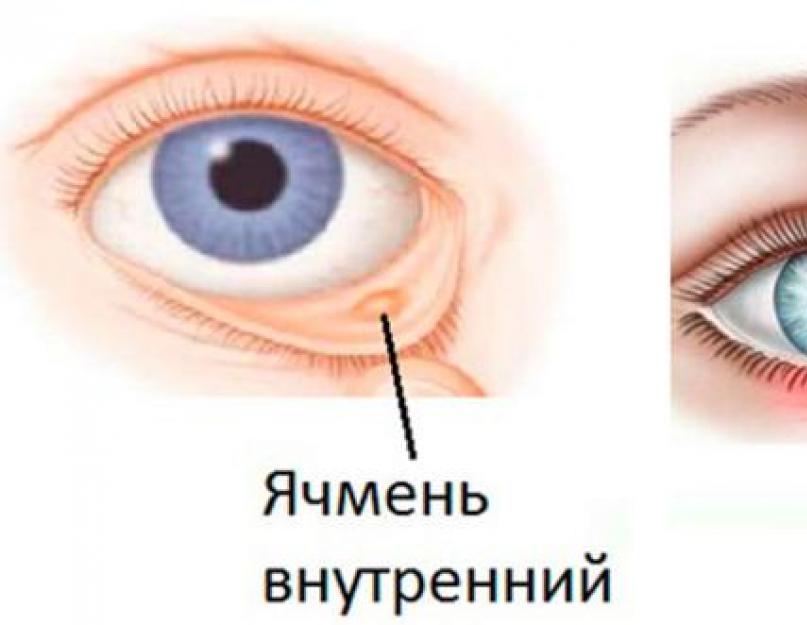 नेत्र रोग जौ।  आँख पर जौ का इलाज कैसे करें, बूँदें, मलहम, शीघ्रपतन से छुटकारा पाने के उपाय।  क्या जौ को आँख पर गर्म करना संभव है?