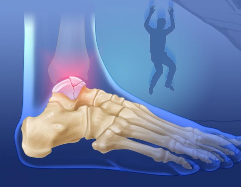 पैर का तालु.  पैर के तालु का फ्रैक्चर: परिणाम।  पैर के टेलस के फ्रैक्चर के उपचार के लिए आधुनिक शल्य चिकित्सा पद्धतियाँ परिणामों के विस्थापन के साथ टेलस के फ्रैक्चर