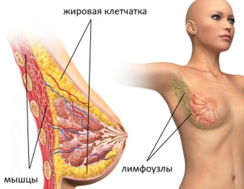 स्तन ग्रंथि को हटाने के लिए एक प्रमुख ऑपरेशन के रूप में रेडिकल मास्टेक्टॉमी।  मास्टेक्टॉमी मास्टेक्टॉमी सर्जन