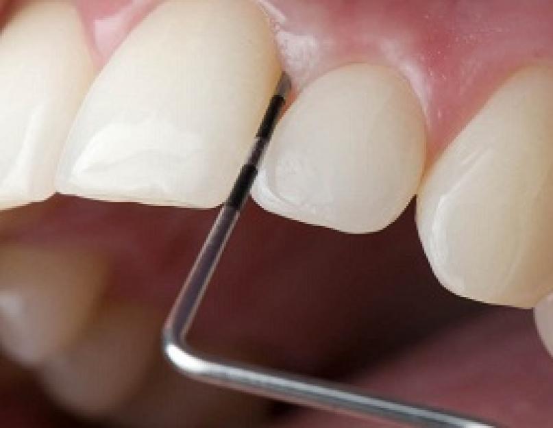 गम पॉकेट्स का इलाज: इस प्रक्रिया के बारे में वह सब कुछ जो आपको जानना आवश्यक है।  दंत चिकित्सा में सर्जिकल हस्तक्षेप - इलाज: यह क्या है, बंद इलाज के बाद तकनीक और परिणाम