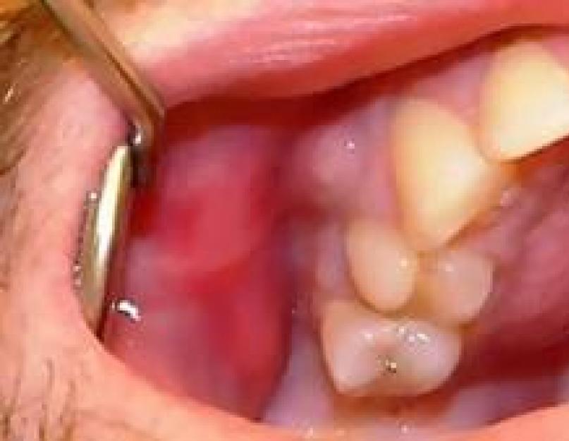 Воспаление надкостницы зуба: лечение, симптомы периостита. Чем опасно воспаление надкостницы зуба, методы лечения Воспаление надкостницы зубного корня