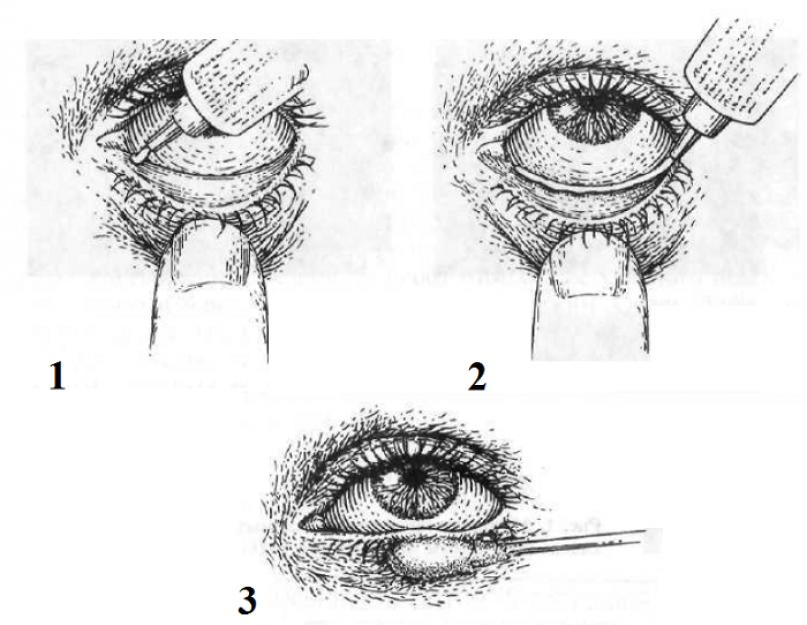 Как применять тетрациклиновую мазь для глаз. Для чего и как применять тетрациклиновую мазь Тетрациклин мазь показания к применению