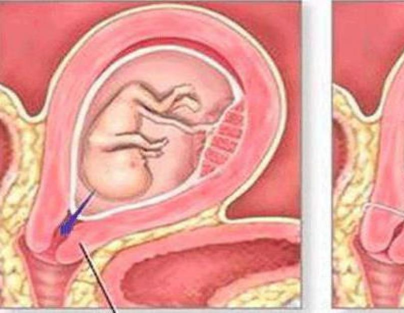 गर्दन पर सिलाई करने के बाद डिस्चार्ज करें।  गर्भावस्था के दौरान गर्भाशय ग्रीवा पर टांके लगाने के बाद खूनी निर्वहन।  संभावित समस्याएं और जटिलताएं