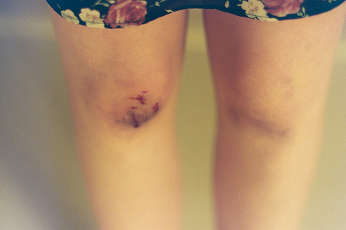 Рваная рана в области коленного сустава thumbnail