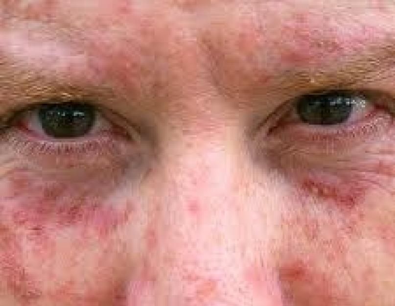 Почему на лице появляются красные пятна. Красное лицо, красные пятна (точки) на коже лица у ребенка, у взрослого – причины, диагностика и лечение, фото