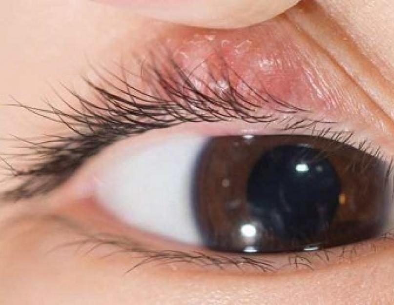Silmalaugud valutavad, mida teha.  Silm valutab ülemise silmalau all - infektsiooni või vigastuse tagajärg
