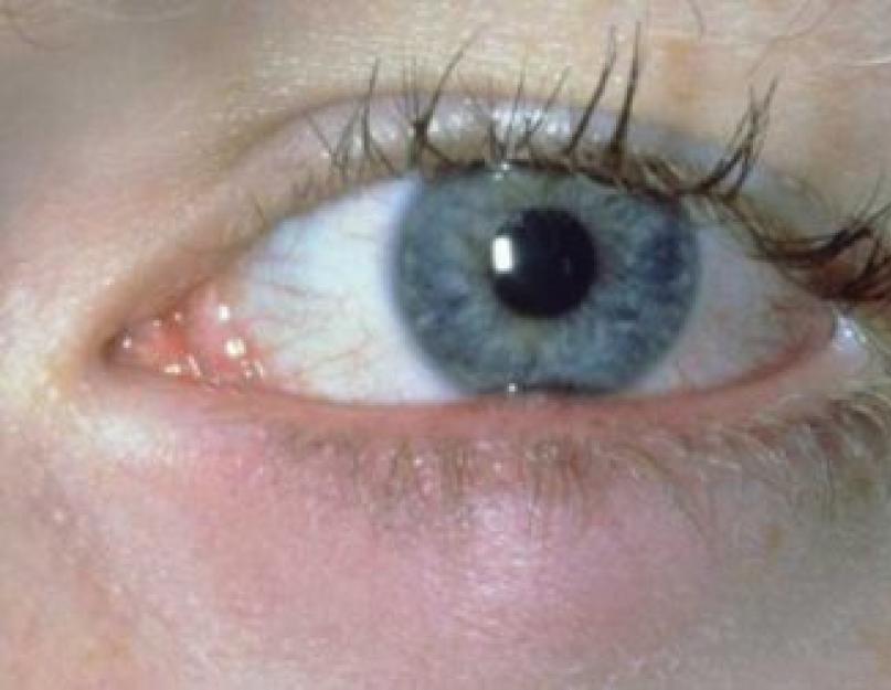 आंख पर गुहेरी के कारण.  आँख पर जौ: कारण और प्रभावी रोकथाम के उपाय